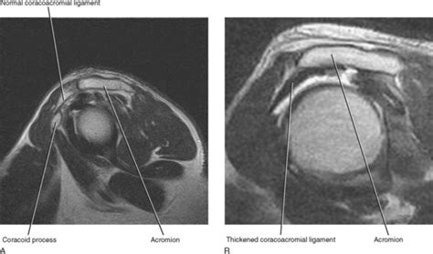 Coracohumeral Ligament Mri