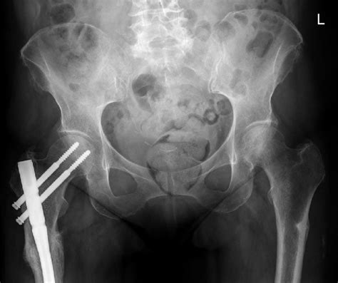 Pelvis X-ray with anteroposterior view showing right femoral nailing as... | Download Scientific ...