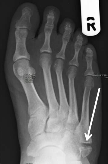 5th Metatarsal Fracture