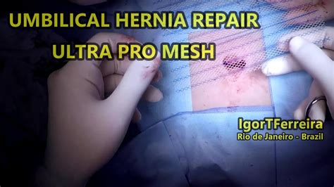 Laparoscopic Umbilical Hernia Repair Anatomy