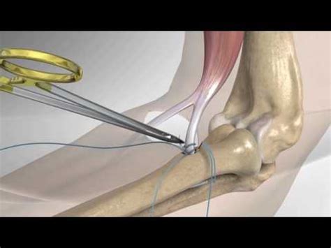 Distal Biceps Repair with Arthrex® Tension Slide - YouTube