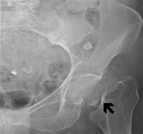 X-ray of the left hip and femur: a left subcapital femoral neck... | Download Scientific Diagram