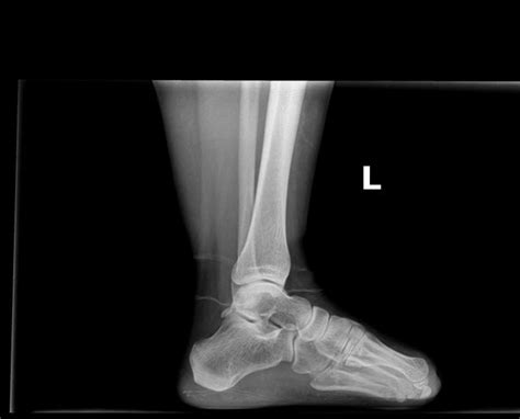 Xrays of both feet. 26 F Adams-Oliver Syndrome : r/adamsoliversyndrome