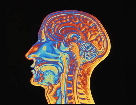 Coloured Mri Scan Of The Human Head (side View) Photograph by Pasieka