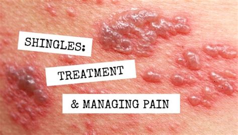 Shingles: Treatment and Managing Pain - WCEI - Blog WCEI – Blog