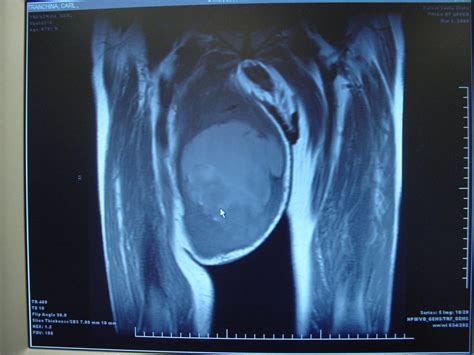 Soft Tissue Neoplasm 4246 Thigh Soft Tissue Sarcoma Mfh | Surgery Photos