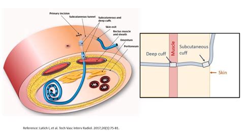 Bedside Ultrasonography of the Peritoneal Dialysis Catheter - Renal Fellow Network