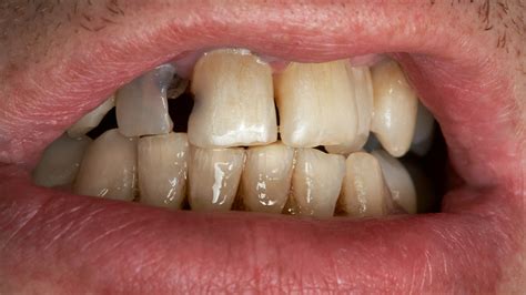 5 Major Ways Tooth Decay Can Negatively Impact Your Health