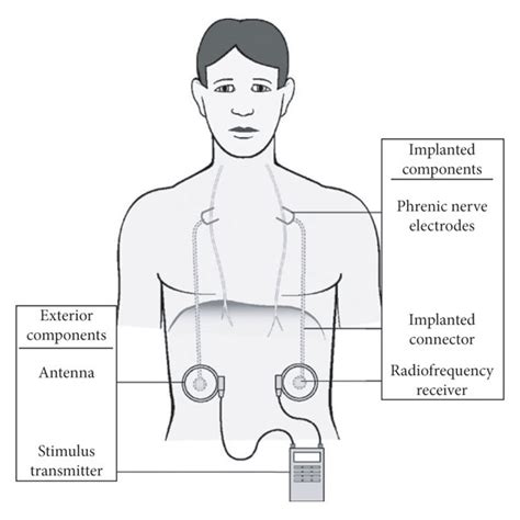 Animal model of closed-loop diaphragm pacing system [81]. The system... | Download Scientific ...