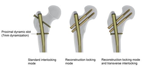 Femoral Recon Nail System