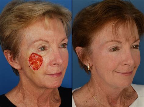 Skin Cancer Reconstruction Photos | Naples, FL | Patient 12033