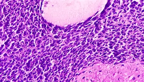 Synovial Sarcoma | Moffitt