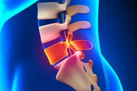 Bulging Disc L4/L5 - Symptoms and Treatment