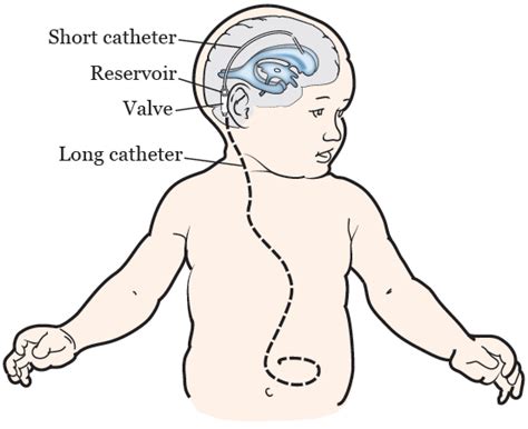 About Your Ventriculoperitoneal (VP) Shunt Surgery at MSK Kids | Memorial Sloan Kettering Cancer ...