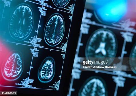 158 Dementia Brain Scan Stock Photos, High-Res Pictures, and Images - Getty Images