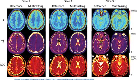 Radiology on Twitter: "Whole-brain multiparametric quantitative MRI frameworks encompassing ...