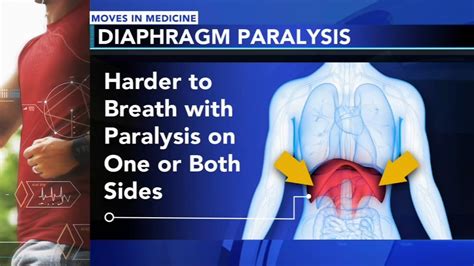 Diaphragm paralysis: What it is, diagnosis, prevention and treatment - 6abc Philadelphia