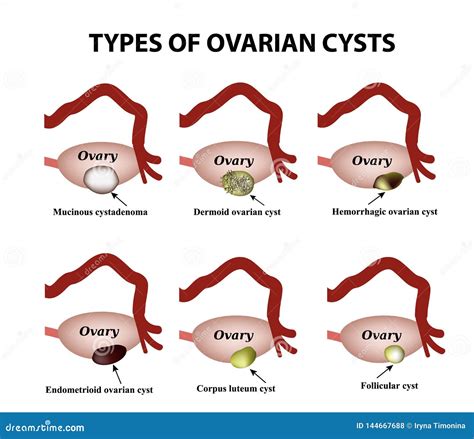 Ovarian Cysts Vector Illustration | CartoonDealer.com #41273162