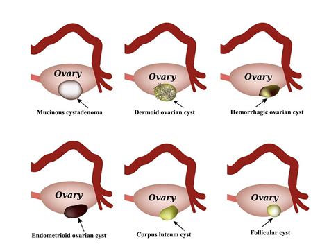 Types Of Ovarian Cysts | Dr. Micheal Tahery