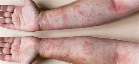 What are the causes of an itchy rash on the body? – Healthy Food Near Me