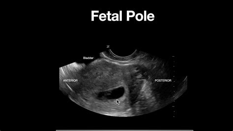 Fetal Pole Diagram