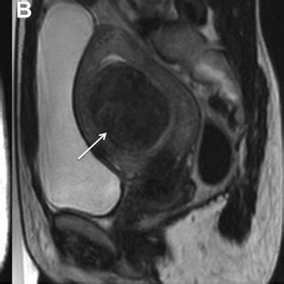 Sagittal T2-weighted MRIs show (A) the intramural uterine fibroid... | Download Scientific Diagram