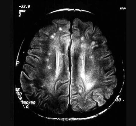 white matter disease mri Mri lesions diffuse axial - Diseases Club center