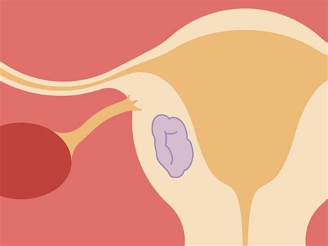 Intramural Fibroid: Symptoms, Diagnosis, and Treatment