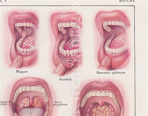 Mouth Diseases Anatomy Plate French Vintage Original Print 1920's Medical Curiosity Cabinet ...