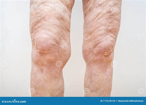 A Lot of Excess Loose Skin on Legs of a Senior Woman after Weight Loss, Gastric Bypass Surgery ...