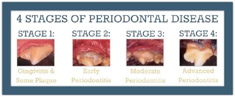 Periodontal Disease Stages