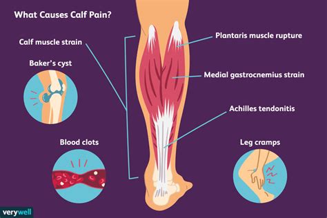 7 Common Causes of Calf Pain and How to Treat Them