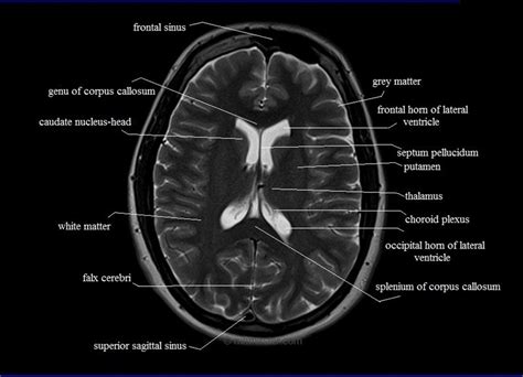 Radiology Anatomy Images Mri Brain Anatomy | Images and Photos finder