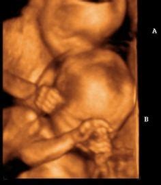 4D ultrasound pictures of twins. "Hey, stop pulling on your brother's ear!" Twins Ultrasound ...