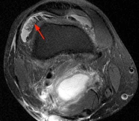 Rheumatoid Arthritis Knee Mri