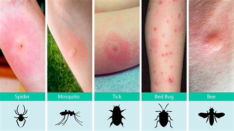 Ouch, What Bit Me? How to Identify Common Bug Bites and What To Do About It - YouTube