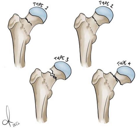 Neck of Femur Fracture - Subcapital - Intertrochanteric - TeachMeSurgery