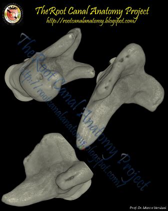 The Root Canal Anatomy Project: Taurodontism: Maxillary Second Molar