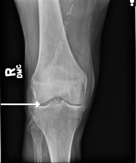 Gout and Calcium Pyrophosphate Deposition Disease