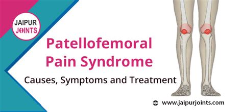 Patellofemoral Pain Syndrome: Causes, Symptoms and Treatment