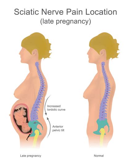 Pregnancy Back Pain Treatment: Causes & Therapy | QI Spine