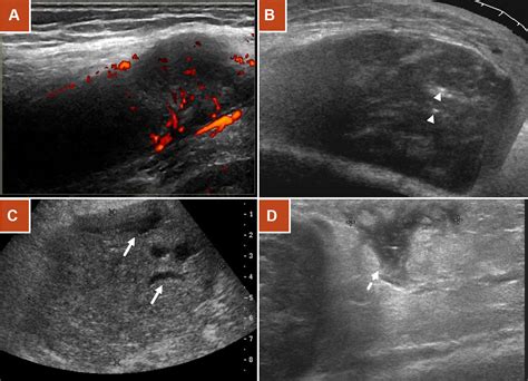 Multimodality-imaging Manifestations Of Primary, 53% OFF