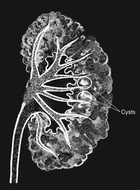 Medullary sponge kidney - Alchetron, the free social encyclopedia