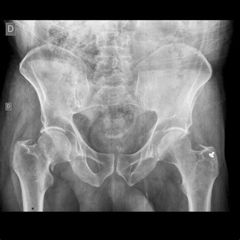 Femoral fracture - Lillia Mowery