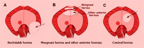 Frequently Asked Questions on the Morgagni Hernia