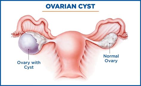 Causes, Symptoms and Treatment of Ovarian Cyst