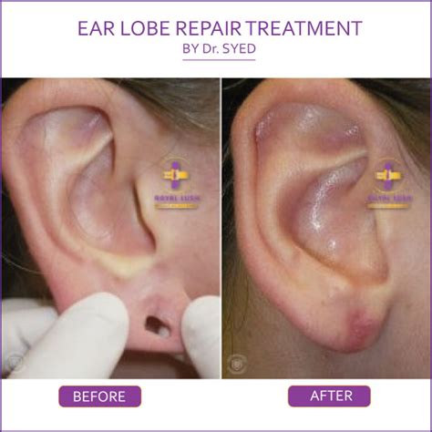 Ear Lobe Repair in south Delhi and Gurgaon - RoyalLush