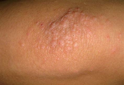 Dermatitis on elbow pictures | Symptoms and pictures