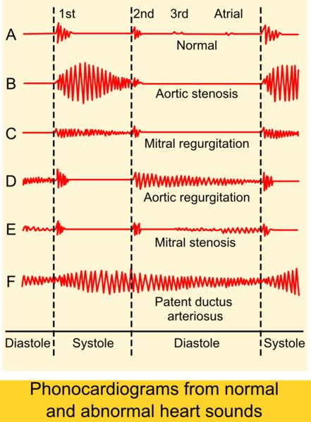 Systolic heart murmur - wikidoc