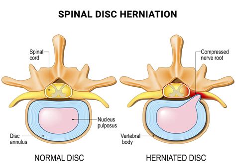 What Are The Symptoms Of A C5-C6 Bulging Disc?